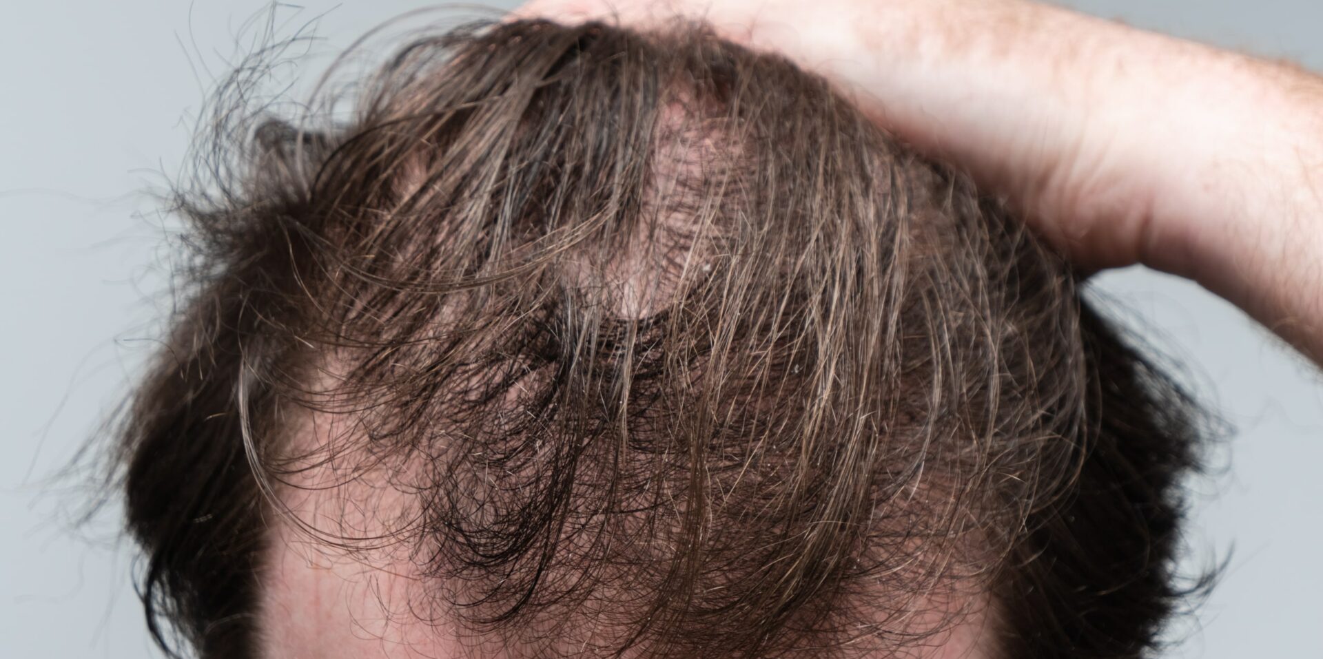 chute-cheveux-traitement-prp